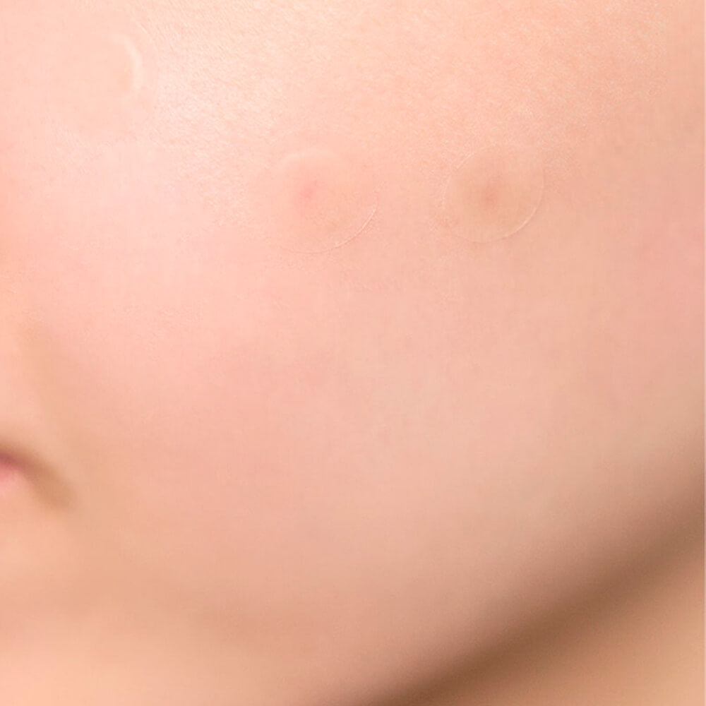 SKIN1004 Spot Cover Patch - Противовоспалительные патчи 22шт